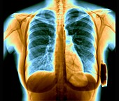 Cardiac defibrillator, chest X-ray