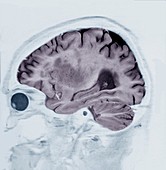 Alzheimer's disease, MRI brain scan