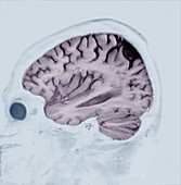 Alzheimer's disease, MRI brain scan