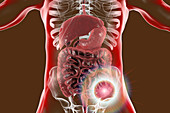 Colon cancer treatment, conceptual illustration