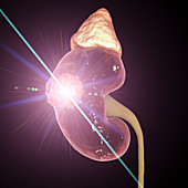 Kidney cancer laser treatment, illustration