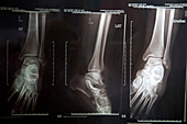 Lower leg X-rays