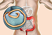 Threadworm infection, illustration