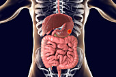 Human stomach cancer, illustration