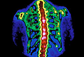 False-col scintigram of human spine and ribs