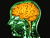 Coloured 3-D MRI brain scan in head cross-section