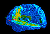 Coloured PET scan of brain responding to pain