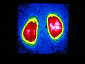Gamma scan of the human kidneys