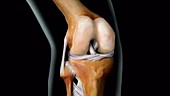 Osteoarthritis, Knee Joint