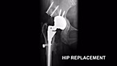 Hip and Knee Replacement, X-Ray