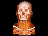 Head and neck, rotating 3D CT angiogram