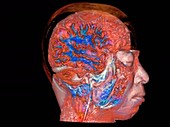 Brain and spinal cord, rotating sagittal MRI scan