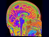 Brain and spinal cord, rotating sagittal MRI scan