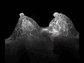 Breast cancer, 3D MRI scan footage