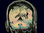 Brain, rotating coronal MRI scan