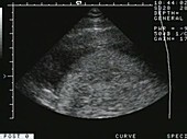 Foetus in the womb, ultrasound