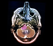 Meningioma brain cancer, MRI scan