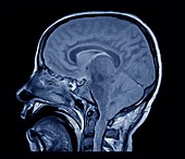 Brain death test, MRI scan