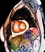 Chronic pericarditis, MRI scan