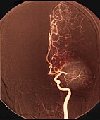 Brain arteries before stroke treatment, angiogram