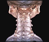 Human cervical spine, 3D CT scan