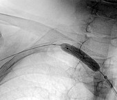Treatment of reduced blood flow, angiogram