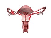 Severe endometriosis, illustration