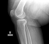 Knee osteoarthritis in obesity, X-ray
