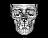 Le Fort skull fractures, 3D CT scan