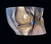 Knee meniscus injury, 3D CT-MRI scan