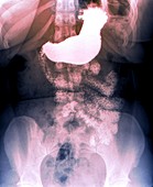 Oeso-gastrointestinal duodenal transit, X-ray