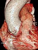 Coronary artery disease, 3D CT angiogram