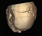 Skull fractures, 3D CT scan