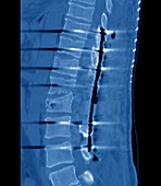 Spinal fusion surgery for broken back, CT scan