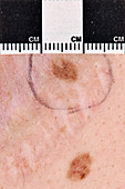 Atypical mole being measured