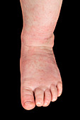 Atopic eczema on a baby's foot