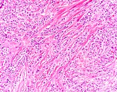 Invasive lobular breast cancer, light micrograph