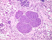 Invasive lobular breast cancer, light micrograph