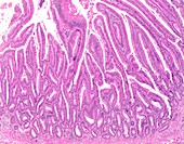 Tubulovillous colon polyp, light micrograph