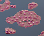 Ovarialkarzinom4 400x - Ovarialkarzinom-Zellen aus Kultur, 400-1