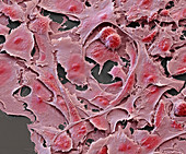 Ovarialkarzinom8 1300x - Ovarialkarzinom-Zellen aus Kultur, 1300-1
