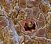 Blood vessel in cancerous tissue, SEM