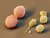 Coloured SEM of leukaemia cells & healthy cells