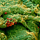 Coloured SEM of an atheroma in an artery