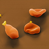 Coloured SEM of red blood cells with Plasmodium