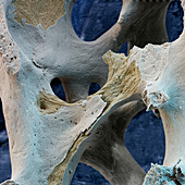 Osteoporosis, SEM