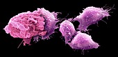 Macrophage and cancer cells, SEM