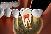 Tooth decay, illustration