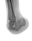 Amputated foot, X-ray