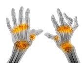 Rheumatoid arthritis of the hands, X-ray